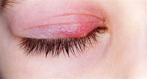 Blepharitis Dr Sandra Cabot Md