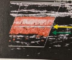 Optimizing Doppler, Aliasing, & Artifacts Flashcards | Quizlet 