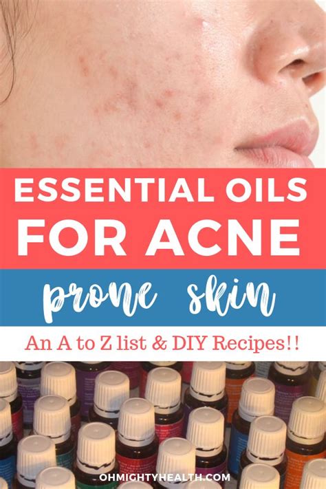 Oily Skin Acne Moisturizer For Oily Skin Diy Serum For Acne Prone