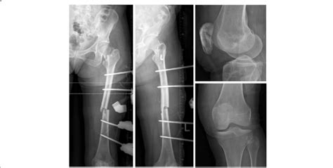 Follow Up Radiograph Of Pelvis At Day Post Op Demonstrating