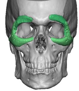 Custom Periorbital Implants D Ct Scan Front View Dr Barry Eppley