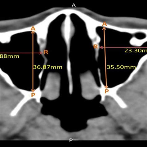 The Width And Length Of The Maxillary Sinus Measured From The