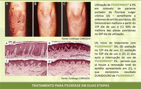 Farmatec Psodermax No Controle E Tratamento Da Psoriase