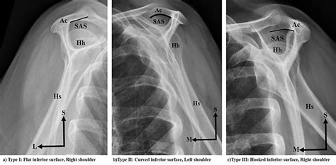 Acromial Types As Proposed By Bigliani Et Al 1986 A Type I Flat