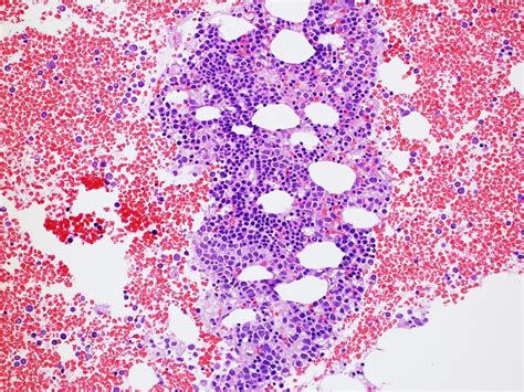 Pathology Outlines Aggressive Nk Cell Leukemia