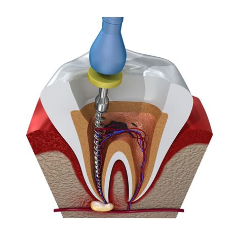endodontics starshine dentistry homeoblock laser sleep dentist