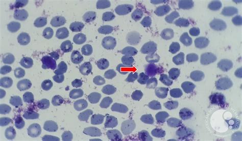 presentation of many large platelets in peripheral blood 2