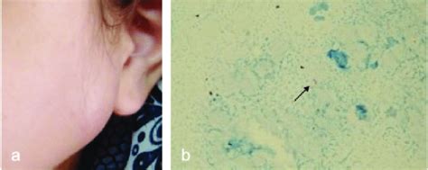 A The Enlarged And Fluctuant Preauricular Lymph Node B Acid Fast