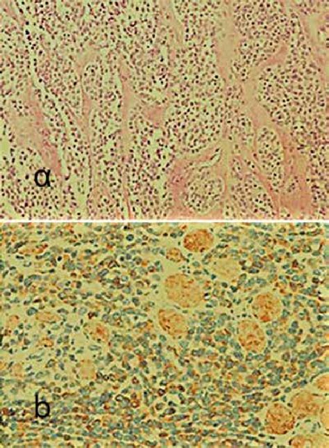 A Diffusely Infiltrating Tumor Cells Loosely Attached To Fibrous