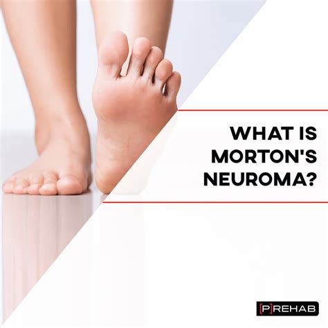 Morton's Neuroma Exercises: Decrease Foot Pain!