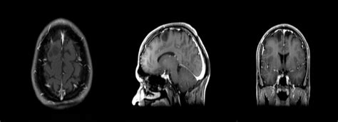 Mri Paracentral Lobule