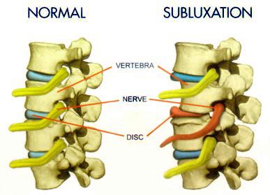 Vertebral Subluxation Treatment - Snyder Chiropractic & Wellness