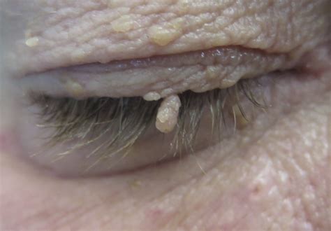 Eyelid Lumps and Bumps (Benign Eyelid Lesions) - Saul Rajak Ophthalmology