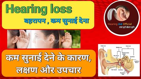 कम सुनाई देने का इलाज Hearing Loss बहरापन क्या है कम सुनाई देने के