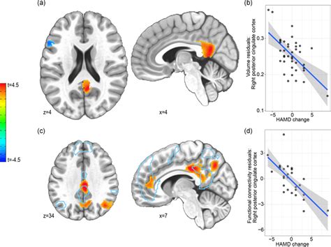 A Increased Gray Matter Volume In The Right Pcc Predicts Symptom