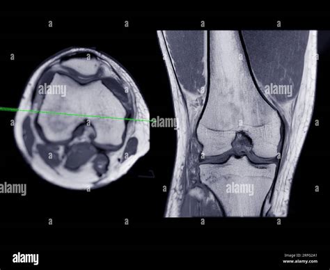 Imágenes por resonancia magnética o RM de la articulación de la rodilla