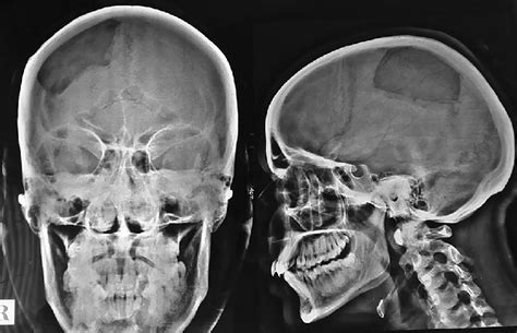 Postoperative X Ray Skull Anteroposterior And Lateral View Showing