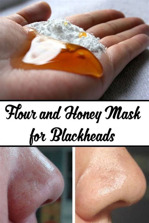 12 Natural Remedies To Get Rid Of Blackheads Quickly Blackhead Mask