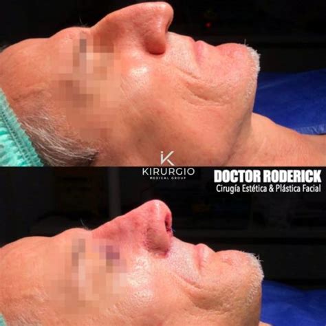 Rinoplastia Barcelona Kirurgio Medical Center