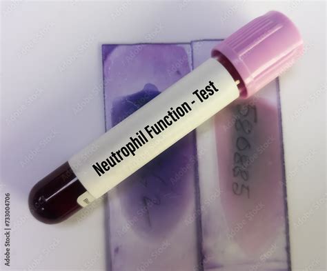 Blood Sample For Neutrophil Function Test Or Dihydrorhodamine Dhr