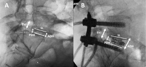 Figure 1 From Clinical And Radiographic Outcomes After Minimally Invasive Transforaminal Lumbar