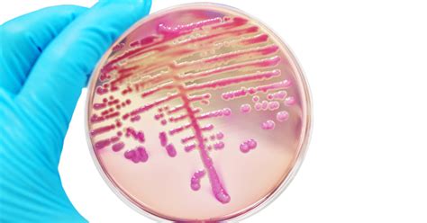 Quando l Escherichia coli è pericolosa Torrinomedica