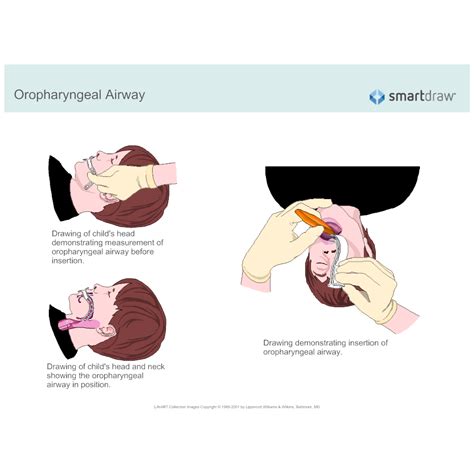 Oropharyngeal Airway Sizes