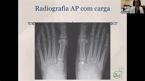 Fratura Luxação De Lisfranc Youtube