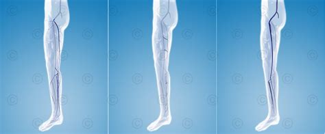 Animation Leg Veins Medicalgraphics