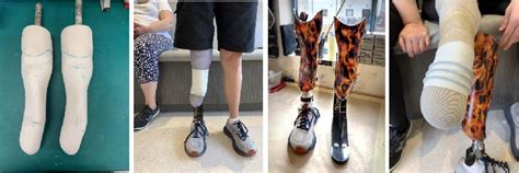 What Materials Are Used For Prosthetics Apc Prosthetics