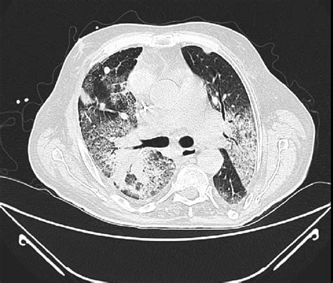 Chest Computed Tomographic Scan Demonstrating Bronchocentric