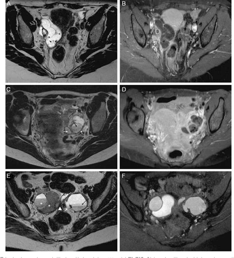 Figure 1 From Fallopian Tube Disease On Magnetic Resonance Imaging Semantic Scholar