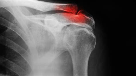 Fracture De La Clavicule Quelle Op Ration Indication Et Proc Dure