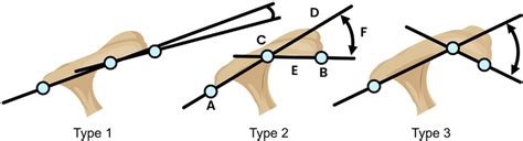 The Acromial Angle And Copenhagen Acromial Curve Classification The