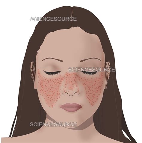 Does Lupus Rash On Face Feel Hot At Sherie Lentz Blog
