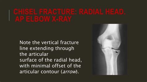 X ray of elbow joint | PPT