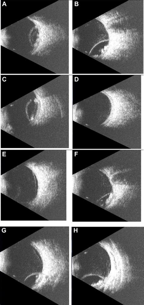 A Series Of B Scan Slices From The Described Ocular Cysticercosis Case