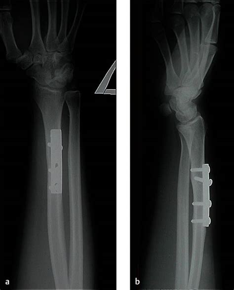 Galeazzi Fracture-dislocation | Musculoskeletal Key