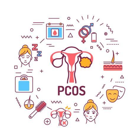 360 Polycystic Ovary Syndrome Stock Illustrations Royalty Free Vector