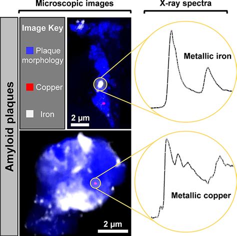 Synchrotron X-ray spectromicroscopy shows metallic particles in Alzheimer’s brains ...