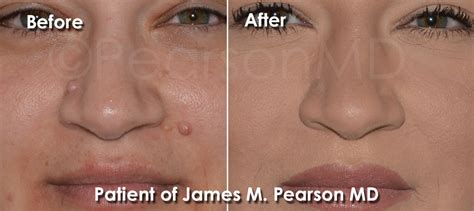 Mole Removal Photos Before And After Dr James Pearson Facial Plastic