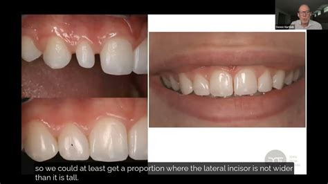 Peg Lateral Restoration Treatment Planning Dental Online Training