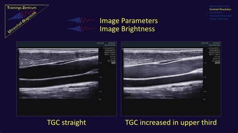 Contrast Resolution In Ultrasound Diagnostic Youtube