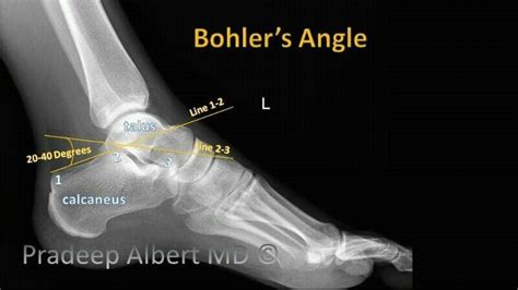 Bohler's angle | X ray, Angles, 40 degrees