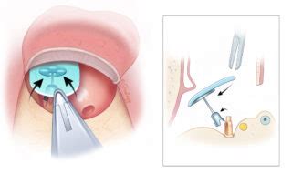 Ossiculoplasty Placement Technique – Oto Surgery Atlas