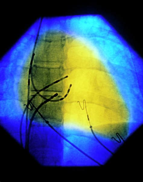 Treatment Of Cardiac Arrhythmia Photograph by Mehau Kulyk/science Photo Library