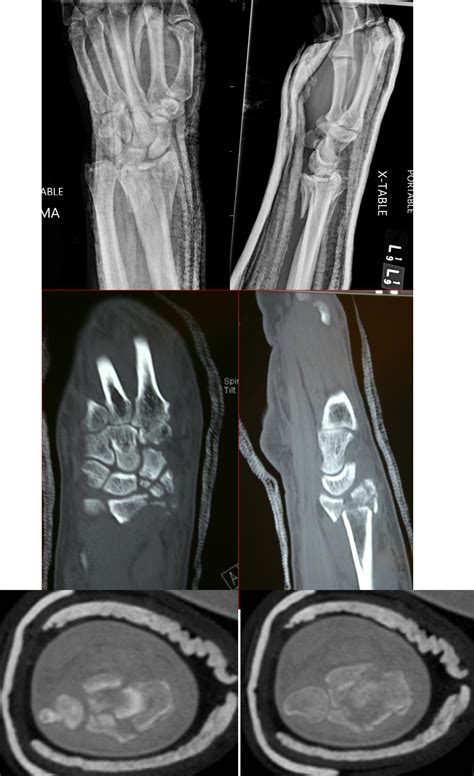 Comminuted Articular Distal Radius Fractures Clinical Tree