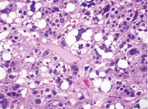 Liposarcoma | Basicmedical Key