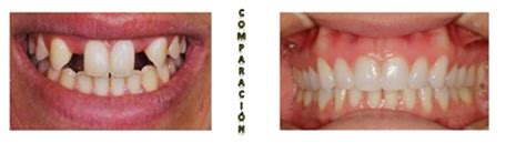 Anodontiacongenital Absence Of Teeth