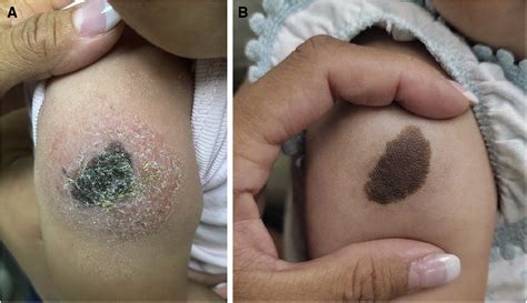 Meyerson Phenomenon Arising From A Congenital Melanocytic Nevus In A